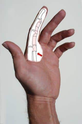 From The Field To The Surgery Trigger Finger Strikes A Champion - pfb4q25